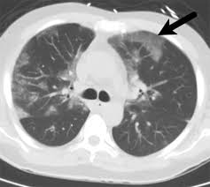 It is most commonly caused by aspiration of oral secretions by patients who have impaired consciousness. Review Of The Chest Ct Differential Diagnosis Of Ground Glass Opacities In The Covid Era Radiology