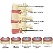 Bandscheibenvorfall Entstehung Symptome Therapie