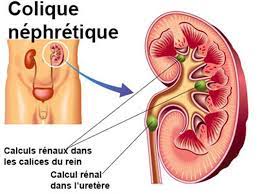 We did not find results for: Colique Nephretique Symptomes Traitement Definition Docteurclic Com