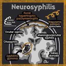 Image result for Neurosyphilis
