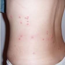 Piqure De Puces Fleas Bites Piqure De Puce Chat Puces Remedes Maison Contre Les Puces