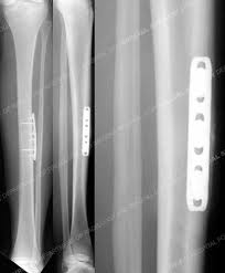 Image result for Tibia Stress Fracture