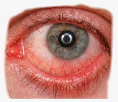 What can you do at home, and when should you see a. Bloodshot Eye Png Images Free Transparent Bloodshot Eye Download Kindpng