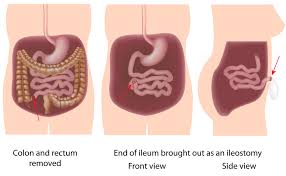 Pan Proctocolectomy With Ileostomy Surgery Ibdrelief
