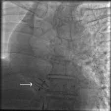 Platypnea Orthodeoxia Syndrome A Rare Complication After Right Pneumonectomy The Annals Of Thoracic Surgery