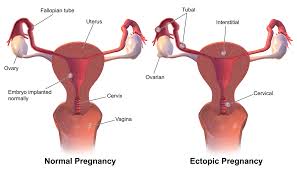 Ectopic Pregnancy Symptoms Causes Treatment In Mumbai India