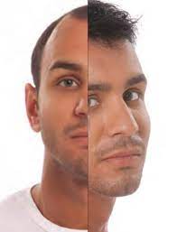 Male Non Surgical Hair Replacement Dubai Baldness Treatment Hair Replacement Natural Hair Loss Treatment