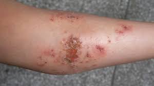 Image result for Stasis Dermatitis