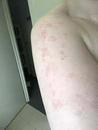 Skin Concerns Strange Red Patches Get Really Red After Showering Red Patch Skin Concern Skin