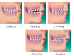 These are the most common causes of underbites, along with how difficult they are to fix. How Can Orthodontic Treatment Change Your Life Orthodontic Excellence
