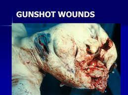 Dec 16, 2018 · gunshot wounds leave circular entry marks on the skin and can even reveal gunpowder residue or even burn marks at close range. Forensic Pathology Gunshot Wounds Ppt Video Online Download