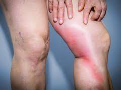Krankenpflege Akademie Tiefe Beinvenenthrombose Tvt Entstehung Therapie Behandlung
