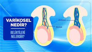 Varikosel Ameliyati Ankara Prof Dr Ahmet Hakan Haliloglu
