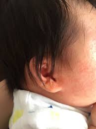 乳児湿疹が出たのでこうした 娘の場合 むさこそブログ