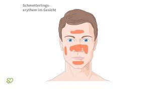 Systemischer Lupus Erythematodes Sle Alles Uber Symptome Therapien Und Verlauf Onmeda De