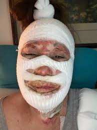 Fundraiser by Vanessa Jordan : Help Me Heal After Being Burnt thru no fault  of my own