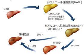 非アルコール性脂肪性肝疾患 非アルコール性脂肪肝炎の自然経過 アルコール 自然 肝炎