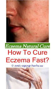 Best Eczema Cream Eczema Cure Natural Cure For Eczema Eczema Treatment