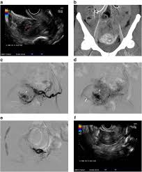 Image result for Retained Placenta