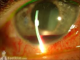 Image result for Hyphema