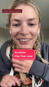 Accutane One Year Update: My Journey with Adult Acne