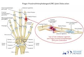 Image result for Lateral PIP Dislocation