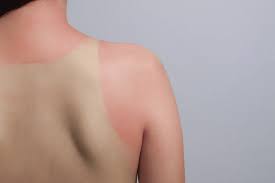 Image result for Sunburn