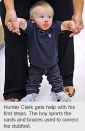 Clubfoot is one of the most common birth defect found in children worldwide. 120 Club Foot Shoes Baby Ideas Club Foot Orthopedics Club Foot Baby