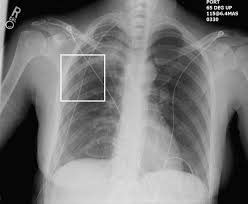 Image result for Small Caliber Chest Tube