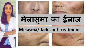 Ayurveda suggests pigmentation treatment for those with excess or less melanin secretion. à¤• à¤² à¤¦ à¤— à¤• à¤ˆà¤² à¤œ Melasma Dark Spots Pigmentation Causes Treatment Hindi Dr Aanchal Panth Youtube