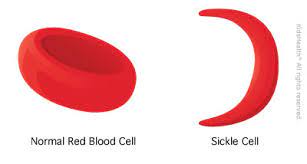 Scd can lead to lifelong disabilities and reduce average life expectancy. Sickle Cell Disease For Teens Nemours Kidshealth