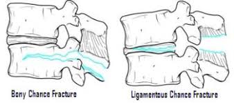 Image result for Chance Fracture