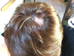 B was i out of my head. I Have A Bald Patch On My Head Menopause Forums Patient