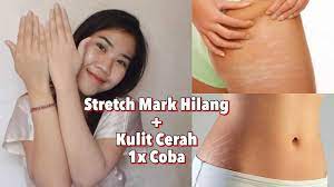 Ada stretch mark di penis, bagaimana cara mengatasinya? Cara Menghilangkan Stretch Mark Skaligus Bikin Kulit Lebih Cerah Instan Pakai Bahan Alami Youtube
