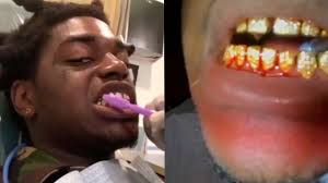 Lil wayne is famous for his rap music. Kodak Black Diamond Teeth Wont Stop Bleeding At Dentist Office Youtube