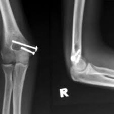 Introduction to telehealth and paediatrics online course: Radiographs Showing United Medial Humerus Epicondyle Avulsion Fracture Download Scientific Diagram