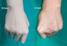 Image result for Elson Extensor Tendon Test