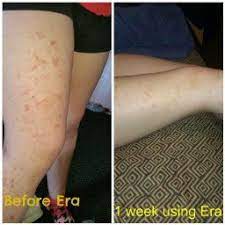 What Common Household Goods Cause Damaged Skin Atopic Dermatitis How To Treat Eczema Psoriasis Herbal Treatment Eczema Treatment