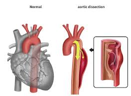 Image result for Aortic Dissection