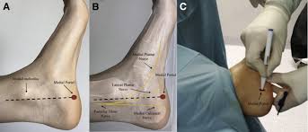 Plantar fasciitis is most common among people ages 40 to 60. Two Portal Endoscopic Plantar Fascia Release Step By Step Surgical Technique Sciencedirect