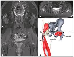 Image result for Hip Apophysitis