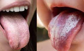 Now that you know a few ways you can tell if you have cancer of the mouth, you must learn about the causes. What Is Oral Candidiasis Or Oral Thrush