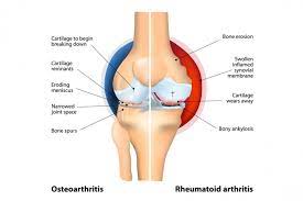 But women tend to develop the disease at a younger age than men. Arthritis Causes Types And Treatments