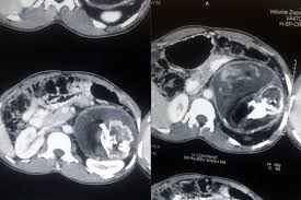 Kita sesekali akan mengalami sakit perut, dan anjing pun demikian. Scary Kembar Dalam Perut Punca Remaja Sakit Perut Mynewshub