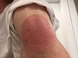 This reaction has primarily been associated with the moderna vaccine although there have been some reports after the pfizer vaccine as well. Rashes Can Occur After Covid Vaccine But Dermatologists Say Dont Worry Community Healthcare System