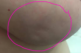 As with other forms of cancer, a person's outlook is more favorable when a doctor detects the disease early. This Is What My Breast Cancer Looks Like Woman S Facebook Photo Of Symptoms Goes Viral