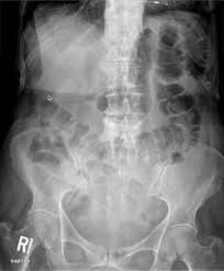 It is of no help in the diagnosis of acute appendicitis or certain other acute conditions such as ruptured ectopic pregnancy. Interpretation Of Normal Plain X Ray Of Abdomen And Indications Jotscroll