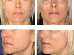 Serdev Sutures in Middle Face