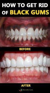 How To Get Rid Of Black Gums Blackgums Gums Https Www Remedieslore Com How To Get Rid Of Black Gums Black Gums Gum Lightening Gum Treatment