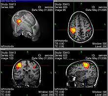 Tinnitus Wikipedia
